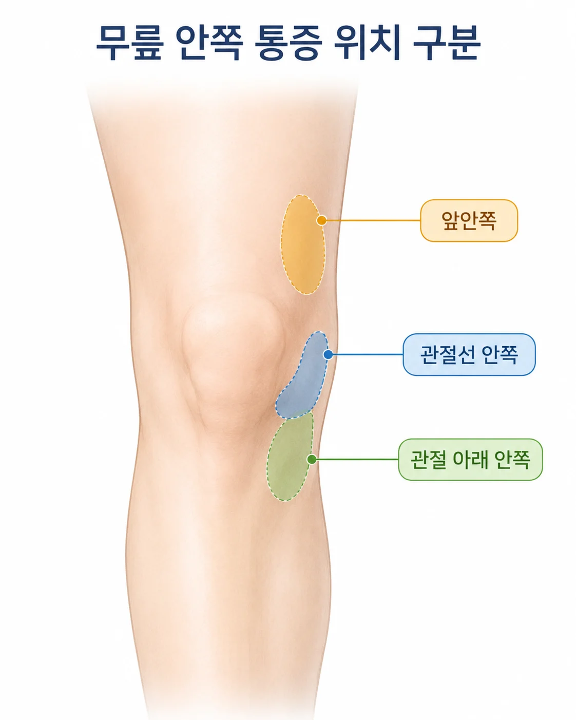 무릎 안쪽 통증 위치를 관절선 안쪽, 관절 아래 안쪽, 앞안쪽으로 나눈 그림
